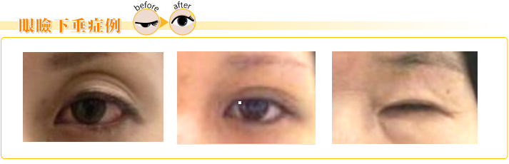 眼瞼下垂症例